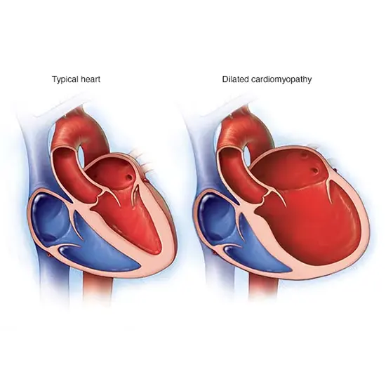 Hypertrophic Cardiomyopathy : Symptoms, Causes and Treatment